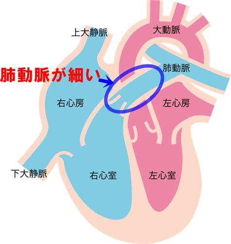 大動脈弁狭窄症により、障害更生年金3級が遡及で受給できた事例です。 請求日は人工弁装着で3級に決定も、障害認定日では不支給に。 事例53：心臓弁疾患 人工弁の装着がなくても3級に認定 （大動脈弁狭窄症、人工弁装着）. 肺動脈狭窄症