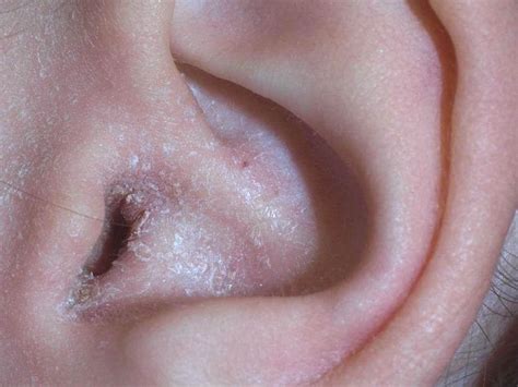 Learning The Truths Yeast Infection Ear
