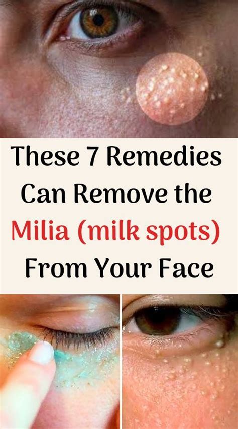 Top 7 Home Remedies To Remove All Milia Permanently Wellness Fill 100