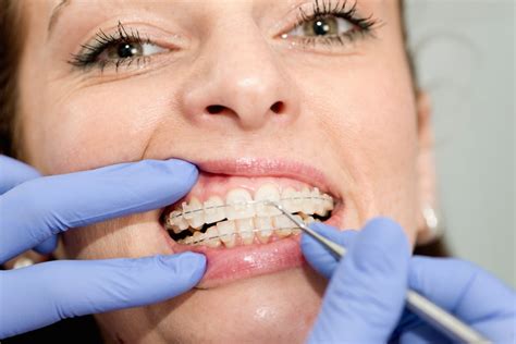 What To Expect At Your Orthodontist Appointments Orthodontic Associates