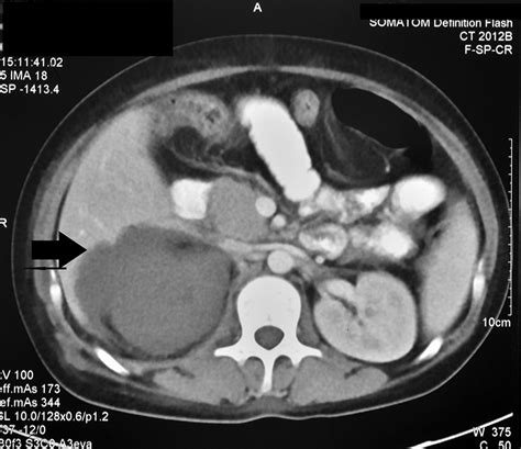 Isolated Renal Mucormycosis In A Patient With Idiopathic Cd4