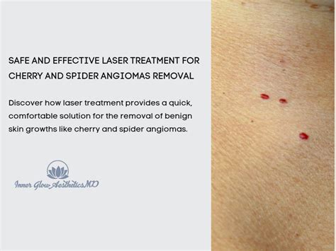 Safe And Effective Laser Treatment For Cherry And Spider Angiomas Removal Inner Glow