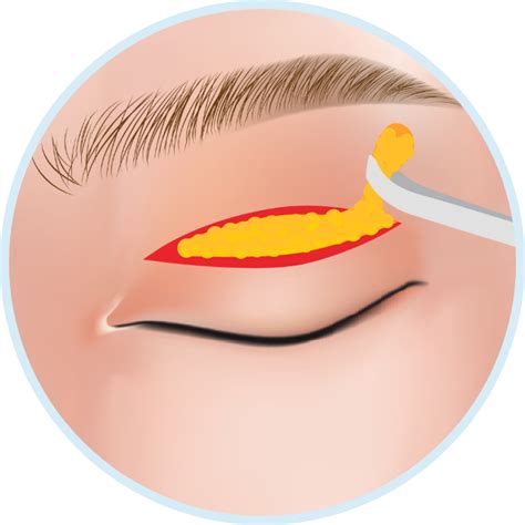 blepharoplasty eyelid surgery international clinics