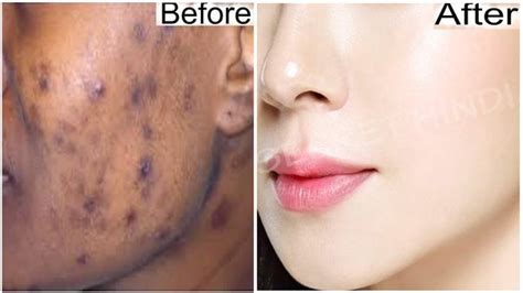 Cream To Remove Black Spots On Face Cheap Price Save 40 Jlcatjgobmx
