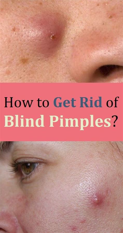 How To Get Rid Of Blind Pimples In 2020 Blind Pimple Painful Pimple