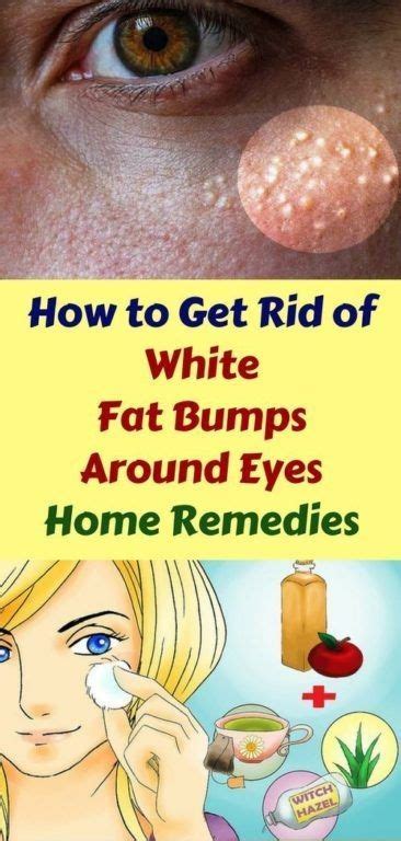 How To Get Rid Of White Fat Bumps Around Eyes Naturally Healthy Lifestyle