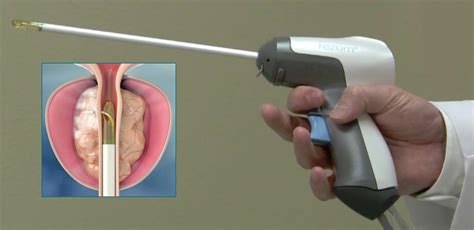 Rezum Suffolk Suffolk Urology Rezum Prostate Treatment In Suffolk