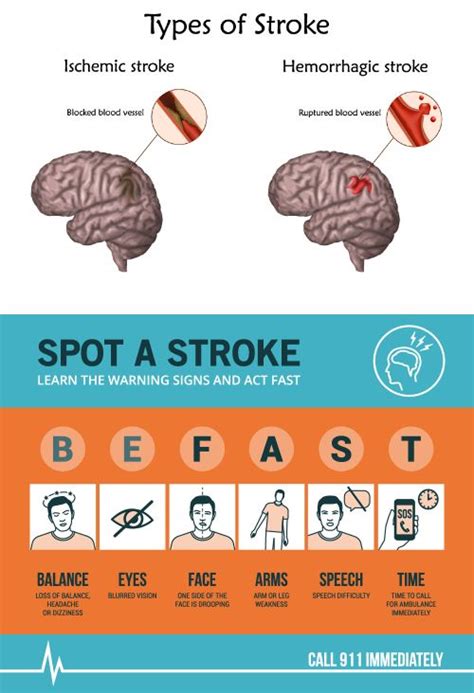 Stroke Also Called Cva Cerebrovascular Accident Medix Urgent Care