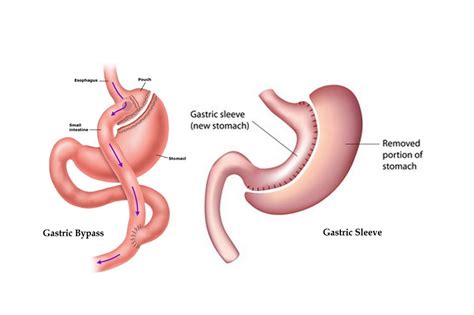 Gastric bypass surgery is an effective way or method for the person who is suffering from obesity. Gastric Bypass vs. Gastric Sleeve