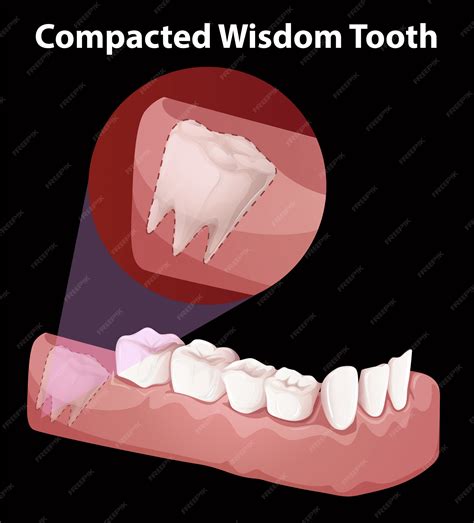 Premium Vector Compacted Wisdom Tooth Diagram