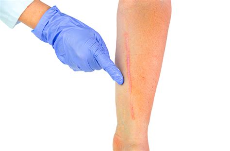 Scar Treatment Wellesley And Boston Ma Krauss Dermatology