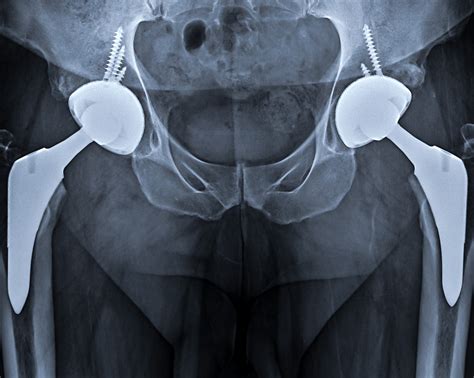 Total Hip Replacement Hip Osteoarthritis