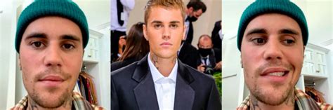 What You Need To Know About Justin Biebers Facial Paralysis Vida