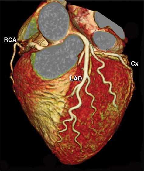 Ct Of Coronary Artery Disease Radiology