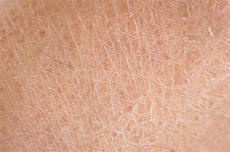 What Is The Relation Of Dry Skin And Eczema Quora
