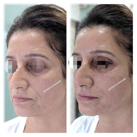 Skin Tightening Treatment In Mumbai Cost Before After Procedures