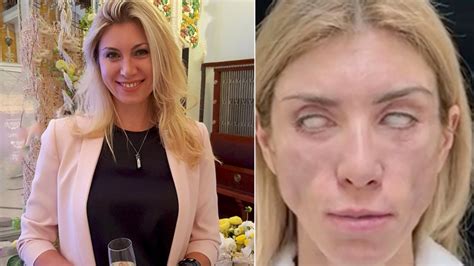 Plastic Surgery Experiences Russian Beauty Queen Says Shes ‘disfigured After 5000 Treatment
