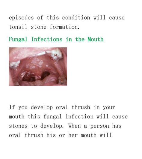 How Do You Get Tonsil Stones Eight Of The Most Common Causes