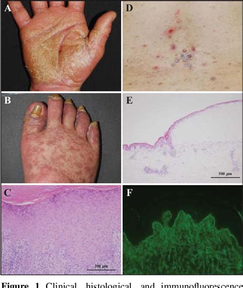 Figure 1 From A Case Of Lichen Planus Pemphigoides With Palmoplantar