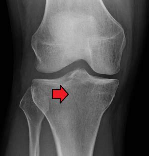 Fracture running tibial plateau stress Diagnosis of