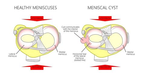 Meniscus Dubai Sports Orthopaedics