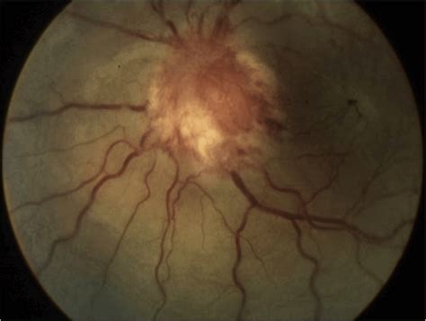 Fundus Photograph Of The Left Eye Of A Patient With Cat Scratch Disease