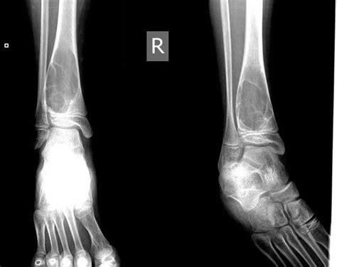 Figure Ankle Radiograph Aneurysmal Bone Cyst Abc Statpearls