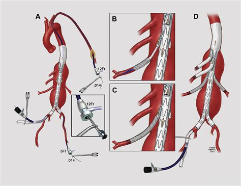 Endovascular Repair Of Thoracoabdominal Aortic Aneurysm Using The Off