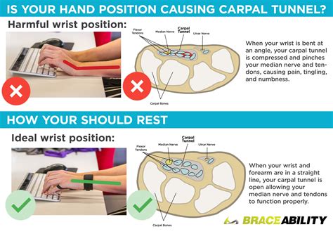 Carpal Tunnel Syndrome Symptoms Wrist Injury Causes And Pain Treatment