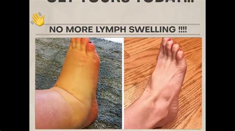 🌿 No More Leg Swelling With 100 Herbal Ginger Oil Lymphatic Drainage