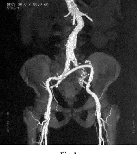 Figure 3 From A Case Of Isolated Internal Iliac Artery Aneurysm With