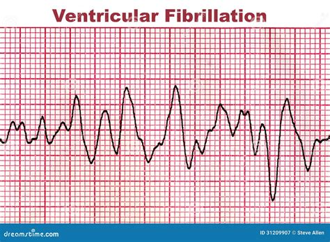 Ventricular Fibrillation Deadly Heart Arrhythmia Stock Illustration