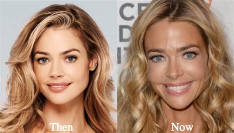 Denise Richards Plastic Surgery Before And After