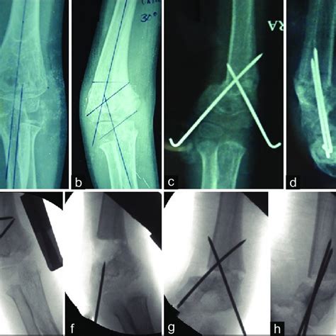 Pdf Correction Of Cubitus Varus With Lateral Closed Wedge Osteotomy