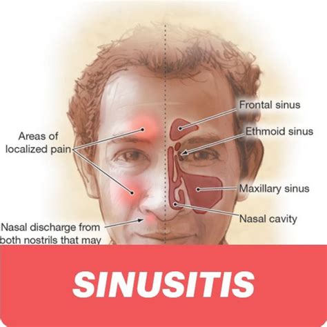 Sinusitis Types Causes Symptoms Complications Sinusitis Chronic