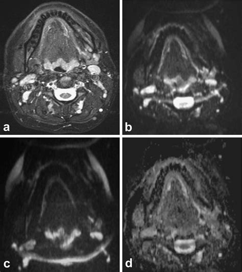 Value Of Diffusion Weighted Mr Imaging In The Differentiation Between