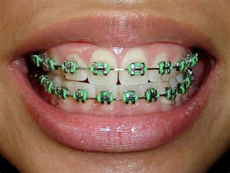 How Green Braces Are Perfect Choice For Your Teeth With Images Dental Braces Colors Braces