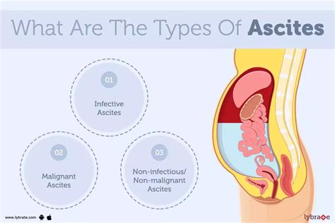 Ascites Causes Symptoms Treatment And Cost