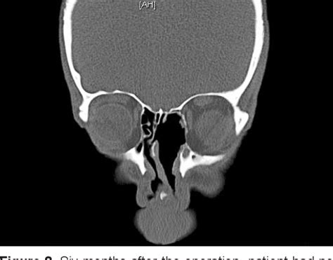Figure 2 From A Case Of Giant Ethmoidal Osteoma With Orbital Invasion