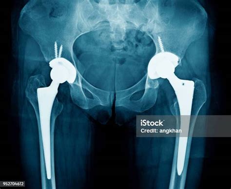 Xray Hip Arthroplasty Hight Quality Xray Image Hip Replacement Stock
