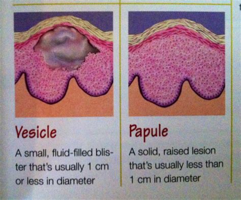 Types Of Lesions Vesicle And Papule ” Nclex Nclex Rn Nursing Exam