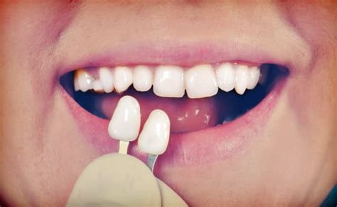 Tooth Transformations With Dental Veneers Dental Veneers Michigan