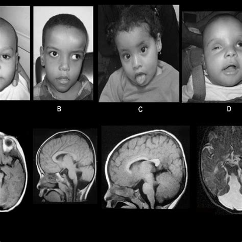 Case 17 With Lissencephaly Cerebellar Hypoplasia Lch Note A Severe
