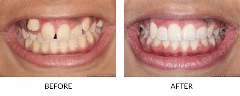 accelerated adult orthodontics san diego la jolla cosmetic dentistry and orthodontics
