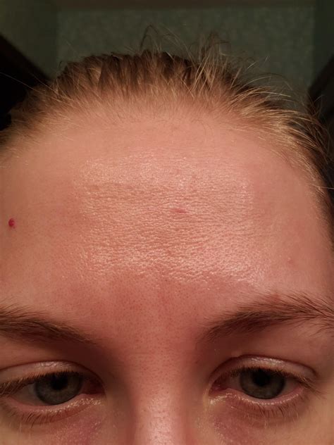 Skin Concerns How Do I Fix This Crepe Y Forehead Texture R