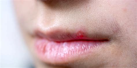 Pimple On Lip Causes Treatment And Prevention