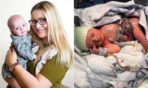 Baby Born With Her Intestines Outside Her Body Is Saved By Doctors