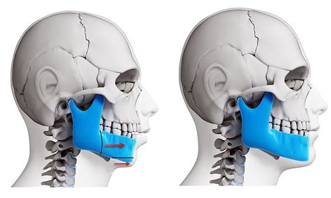 Indications For Orthognathic Surgery Directorio Odontológico