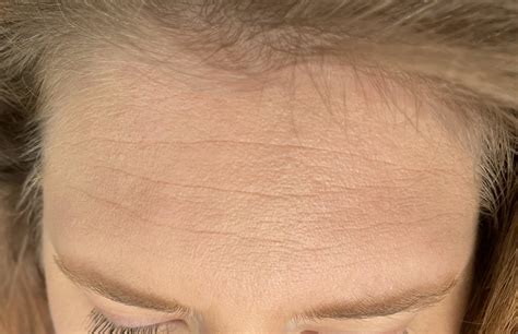 What Are These Tiny Bumps On Forehead R DermatologyQuestions