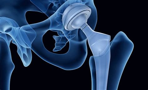 Metallosis From Hip Replacement What You Should Know Florin Roebig
